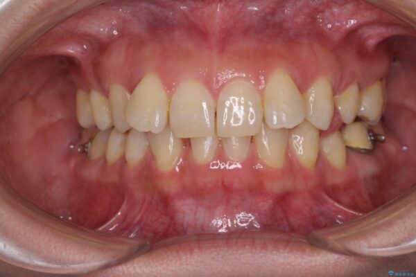 下顎2前歯の欠損　インビザラインによる抜歯矯正 治療途中画像