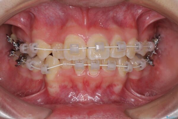八重歯で正中が右にずれている　ワイヤー装置での抜歯矯正で正中位置を改善 治療途中画像