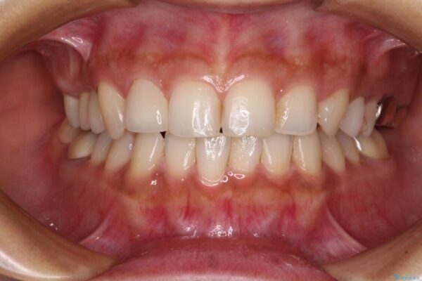 むし歯だらけの歯を治したい　インプラントを用いた補綴治療 治療後画像