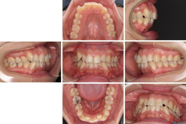 前歯のデコボコを短期間で解消　ワイヤー装置による抜歯矯正 治療前画像