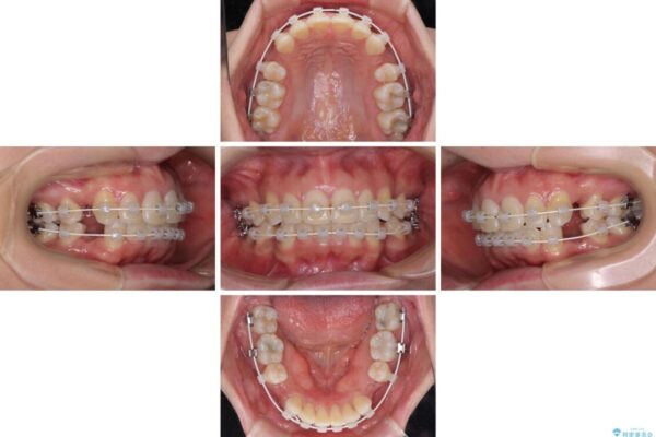 インビザラインが続けられない　ワイヤー装置による抜歯矯正 治療途中画像