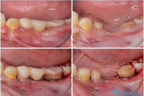 むし歯だらけの奥歯　セラミッククラウンによるむし歯治療 治療途中画像