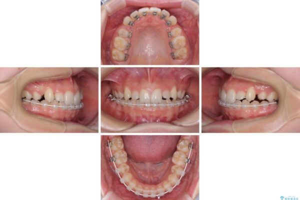 目立つ八重歯を目立たない装置で　ハーフリンガルによる抜歯矯正 治療途中画像