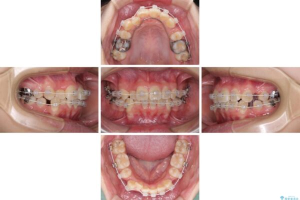 八重歯で正中が右にずれている　ワイヤー装置での抜歯矯正で正中位置を改善 治療途中画像