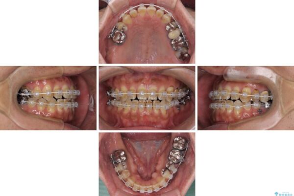 前歯の反対咬合をワイヤー矯正で改善して噛みやすく 治療途中画像