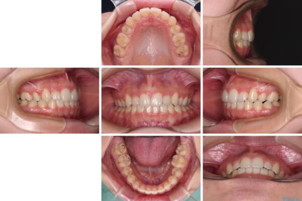 目立つ八重歯を目立たない装置で　ハーフリンガルによる抜歯矯正 治療後画像
