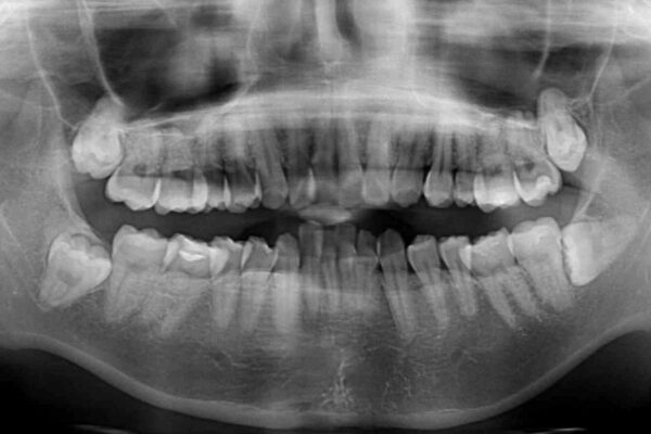 インビザラインが続けられない　ワイヤー装置による抜歯矯正 治療前画像