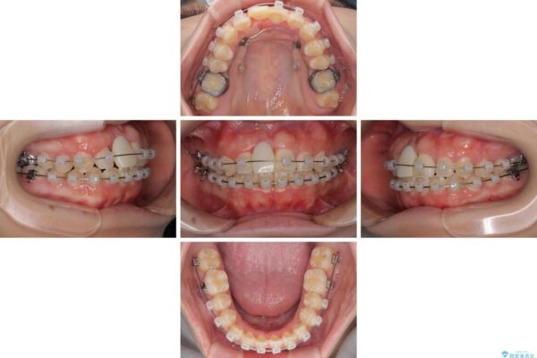 怪我をして不格好な前歯　矯正治療とインプラント補綴治療 治療途中画像