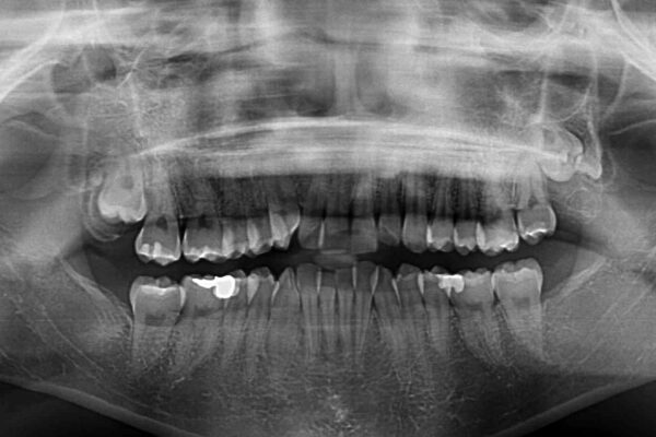 前歯のデコボコを短期間で解消　ワイヤー装置による抜歯矯正 治療前画像
