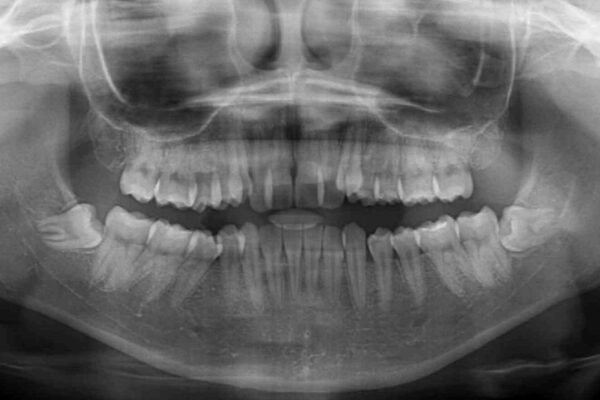 目立つ八重歯を目立たない装置で　ハーフリンガルによる抜歯矯正 治療前画像