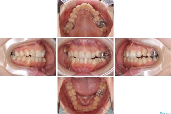 顕著な八重歯をインビザラインで治せるところまで改善 治療途中画像