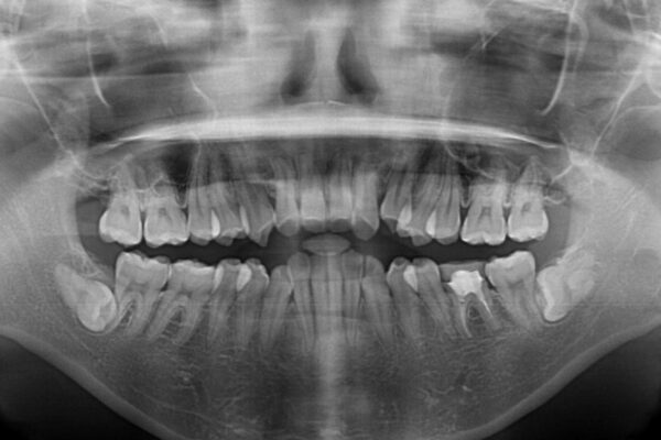 抜歯矯正で閉じにくかった口を閉じやすく改善 治療前画像