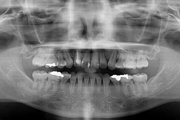 目立たないハーフリンガル矯正　抜歯矯正で口元を改善 治療後画像