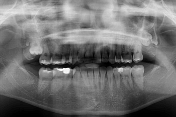 前歯のデコボコを短期間で解消　ワイヤー装置による抜歯矯正 治療後画像
