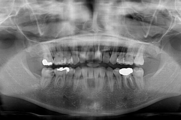 膨らんだ口元が気になる　ワイヤー装置による抜歯矯正 治療後画像