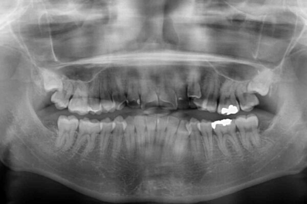 顕著な八重歯をインビザラインで治せるところまで改善 治療前画像