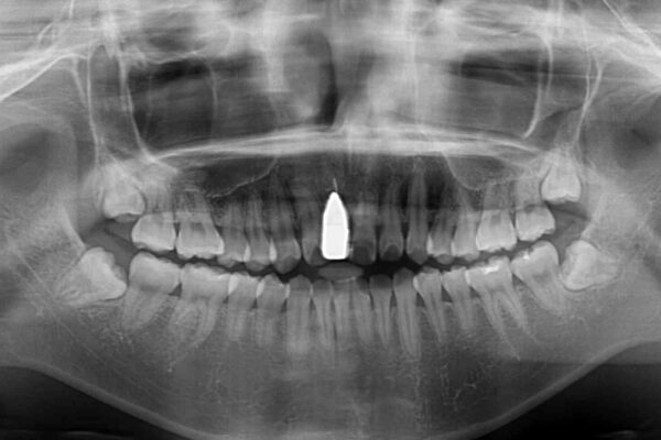 怪我をして不格好な前歯　矯正治療とインプラント補綴治療 治療前画像