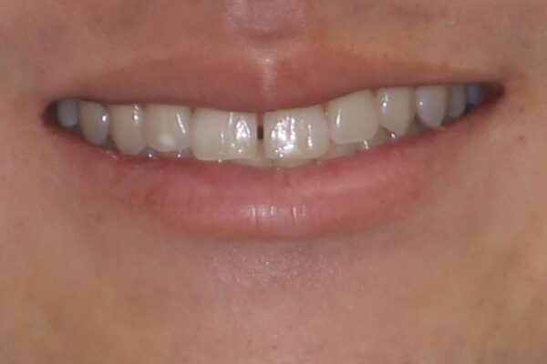 隙間の空いた前歯を治したい　上顎の部分矯正 治療前画像