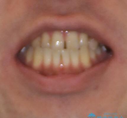 前歯の反対咬合をワイヤー矯正で改善して噛みやすく 治療前画像