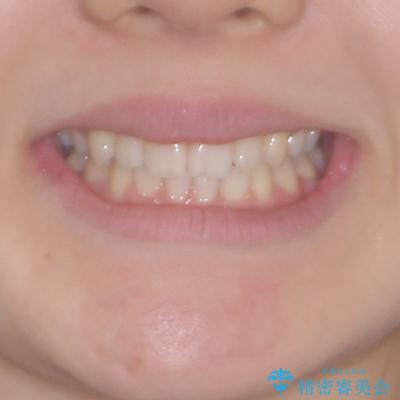 目立つ八重歯を目立たない装置で　ハーフリンガルによる抜歯矯正 治療後画像