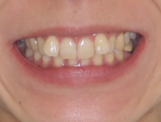 下顎2前歯の欠損　インビザラインによる抜歯矯正 治療前画像