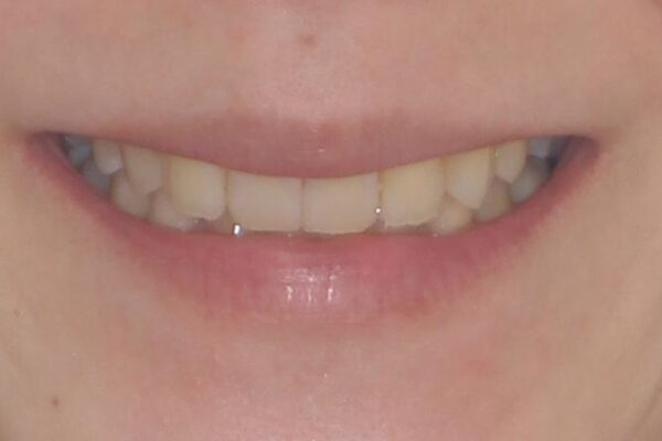 下顎2前歯の欠損　インビザラインによる抜歯矯正 治療後画像