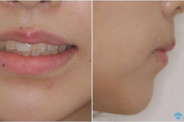 怪我をして不格好な前歯　矯正治療とインプラント補綴治療 治療後画像