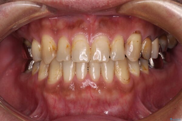 前歯の反対咬合をワイヤー矯正で改善して噛みやすく アフター