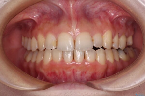 顕著な八重歯をインビザラインで治せるところまで改善 アフター