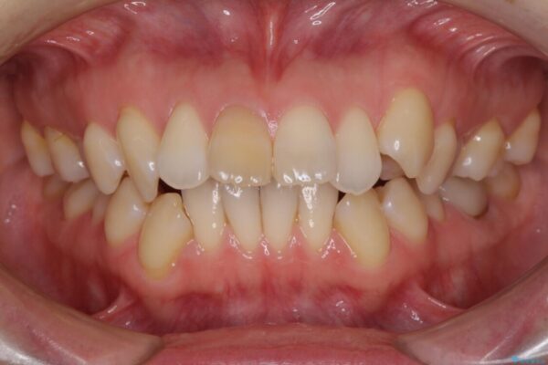 抜歯矯正で閉じにくかった口を閉じやすく改善 治療前画像