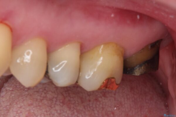 奥歯が外れた　ゴールドクラウンによる補綴治療 治療前画像
