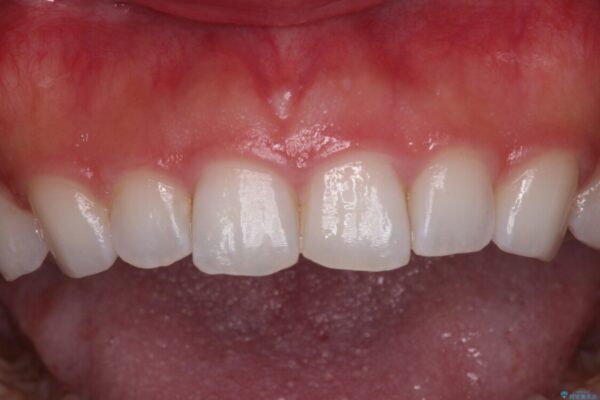 前歯の形を変えたい　前歯のラミネートベニア治療 治療前画像