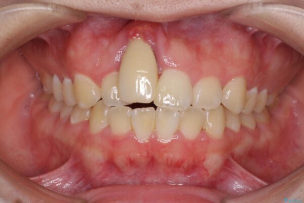 怪我をして不格好な前歯　矯正治療とインプラント補綴治療 治療前画像