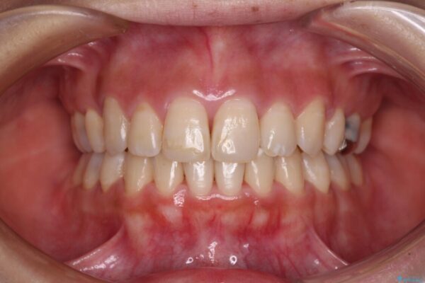 突出した口元が気になる　ハーフリンガル装置による抜歯矯正 治療後画像