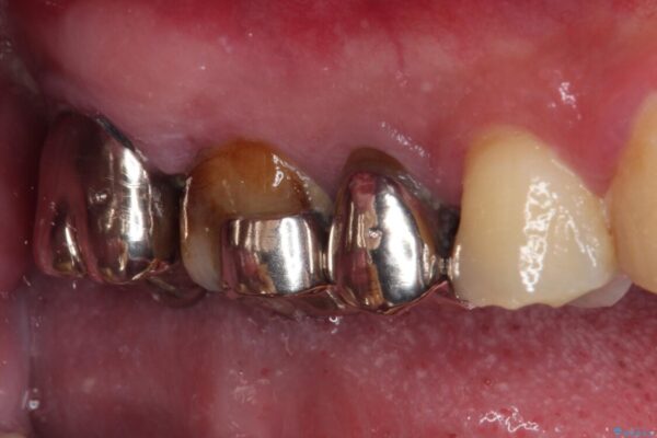 放置して悪化してしまったむし歯を早めに対応　セラミッククラウンによるむし歯治療 治療前画像