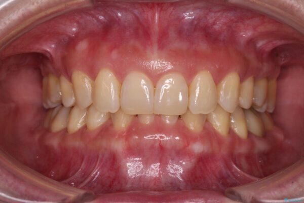 下顎2前歯の欠損　インビザラインによる抜歯矯正 アフター
