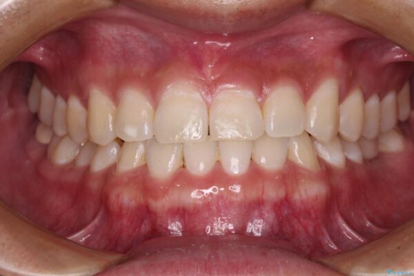 隙間の空いた前歯を治したい　上顎の部分矯正 アフター