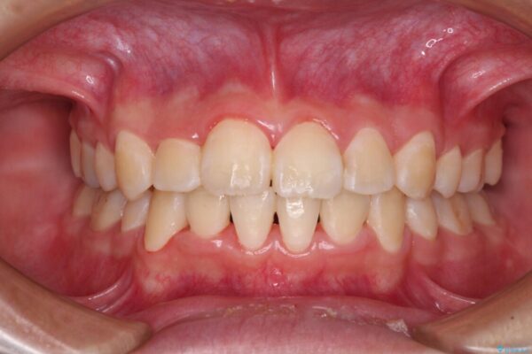 八重歯で正中が右にずれている　ワイヤー装置での抜歯矯正で正中位置を改善 アフター