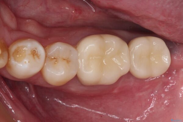 抜歯が必要な奥歯　ストローマン・インプラント補綴治療 アフター