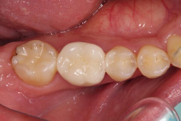 咬み合わせが気になる　ワイヤー矯正による咬み合わせ改善と奥歯のセラミック治療 治療後画像
