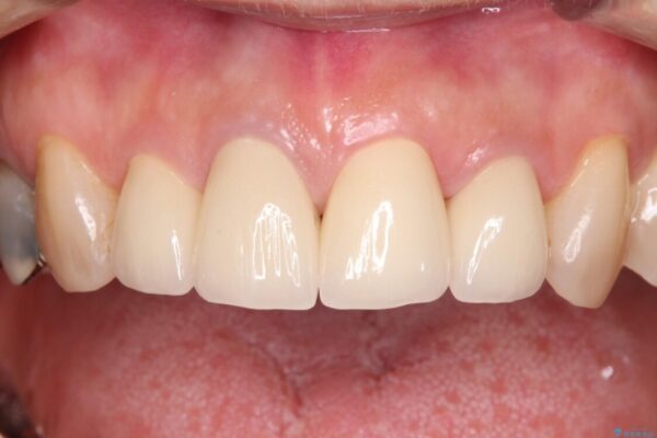 痛む奥歯と見栄えの悪い前歯　オールセラミックによる補綴治療 治療後画像
