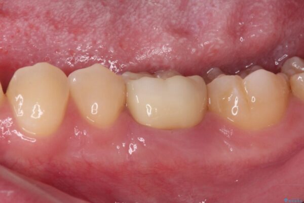 奥歯の被せものが汚れやすい　仮歯のままの歯をセラミッククラウンに 治療後画像
