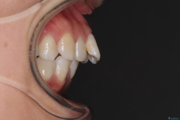 インビザラインが続けられない　ワイヤー装置による抜歯矯正 ビフォー
