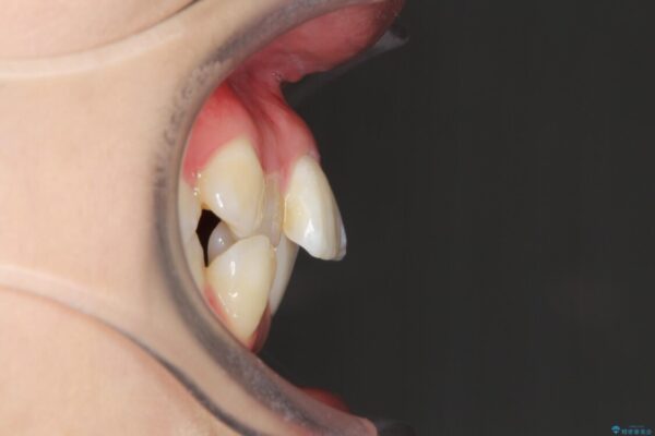 目立たないハーフリンガル矯正　抜歯矯正で口元を改善 治療前画像