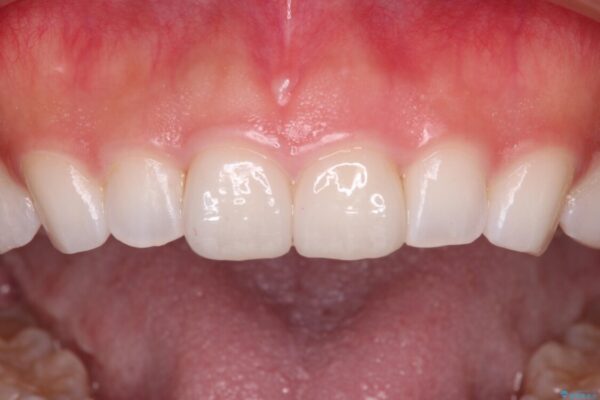 前歯の形を変えたい　前歯のラミネートベニア治療 治療後画像