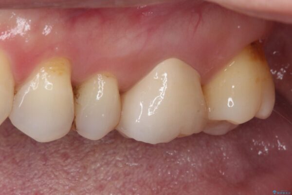 しみる奥歯　セラミッククラウンによるむし歯治療 治療後画像