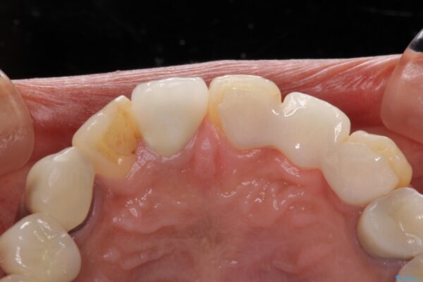 以前治療した歯が続々とむし歯に　全顎むし歯治療 治療前画像