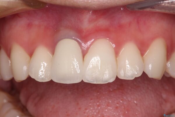 茶色になった前歯　オーダーメイドタイプのオールセラミッククラウン 治療後画像