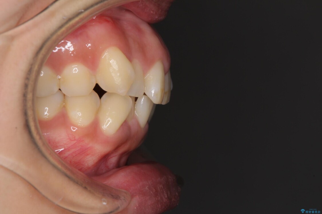 前歯のデコボコを短期間で解消　ワイヤー装置による抜歯矯正 治療前