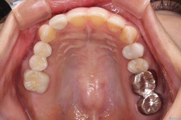 むし歯だらけの歯を治したい　インプラントを用いた補綴治療 治療後画像